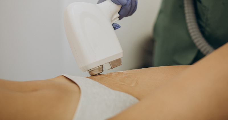 Lāzerepilācija: kas tā ir, kam tā paredzēta un kādus rezultātus sagaidīt