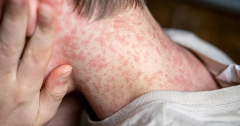 SPKC brīdina par augstu masalu izplatības risku Latvijā