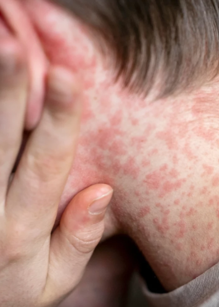 SPKC brīdina par augstu masalu izplatības risku Latvijā